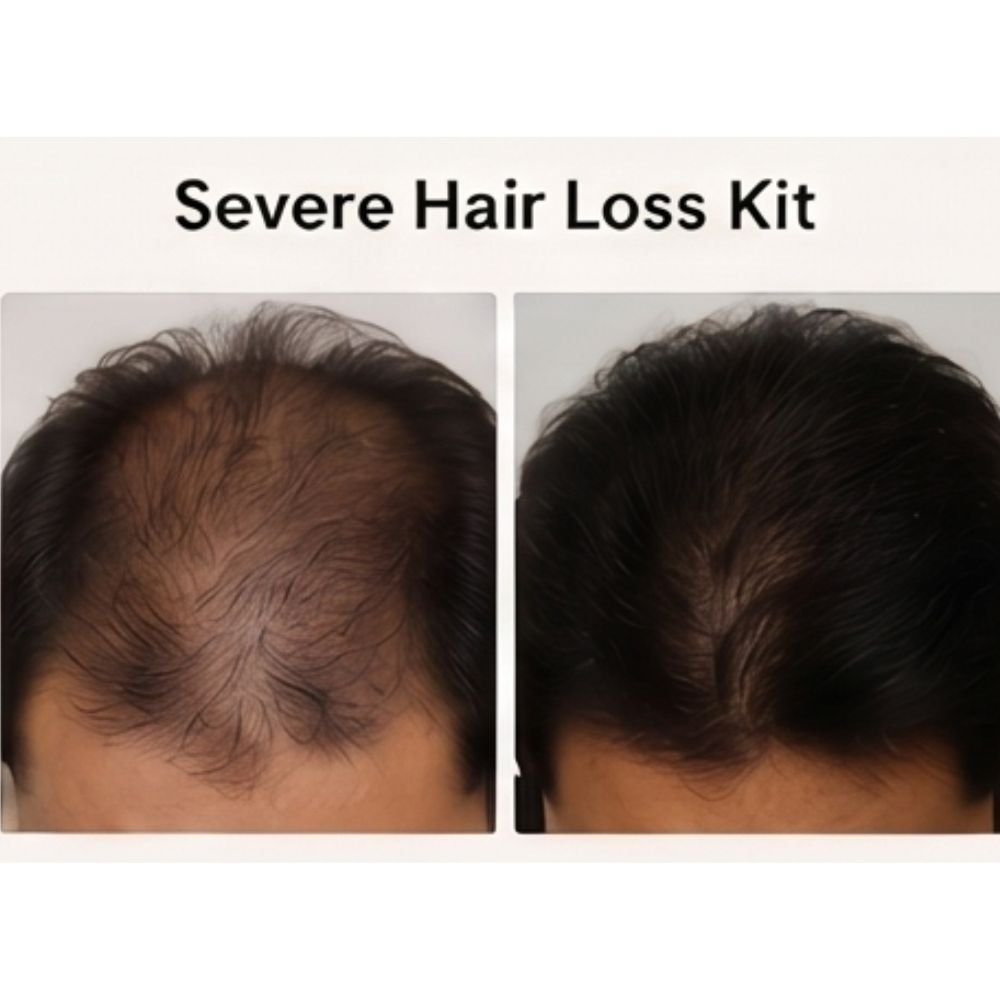 Severe Hair Loss Kit