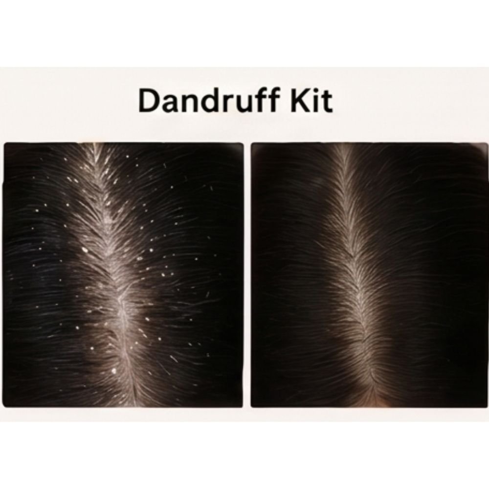 Dandruff Kit