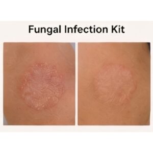 Fungal Infection Kit