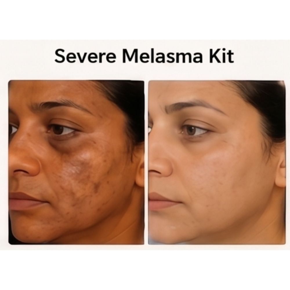 Severe Melasma Kit