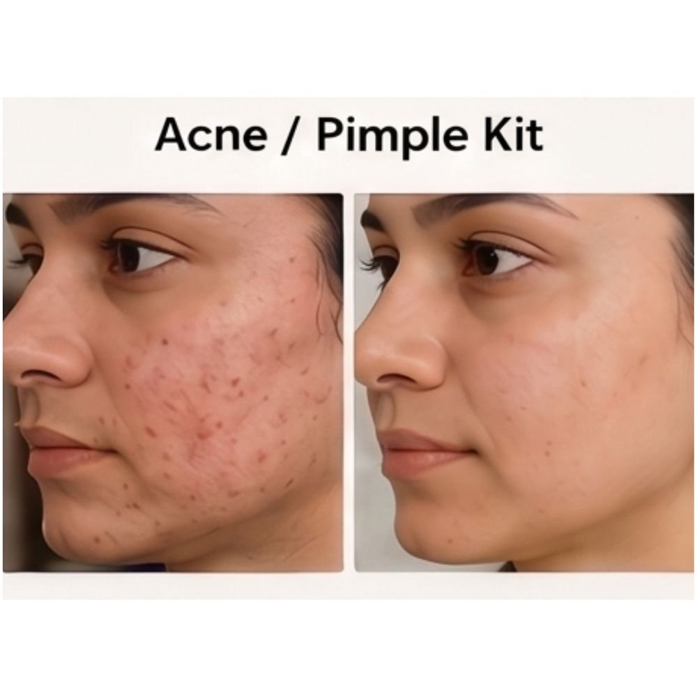Acne / Pimple Kit